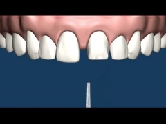 Resistencia a la corrosión de la dentadura del accesorio de la precisión del CR MK1 del CO