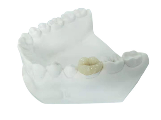 Sobrepuesto dental totalmente de cerámica durable del embutido de la chapa de la corona del FDA similar