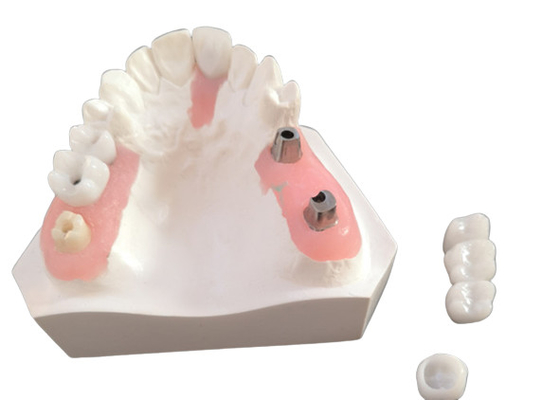 FDA Corona de zirconio con dentaduras con implantes para laboratorio dental