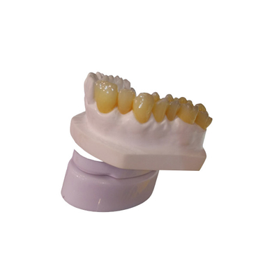 Impresora dental Dental Crowns del laboratorio 3D de la corona del diseño PFM de la leva del cad