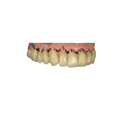 La corona telescópica 3D dental del puente de la corona del implante de la leva PFM del cad imprimió modelos