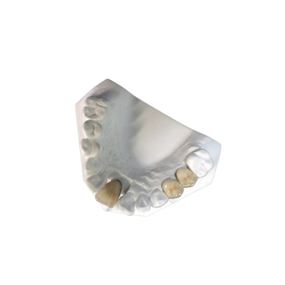 El diente natural de la alta corona dental de cerámica de la estabilidad PFM mancha resistente