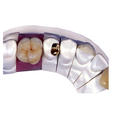 Corona dental de la porcelana de PFM