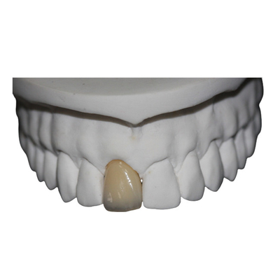 Corona dental de la porcelana del Cr del Co