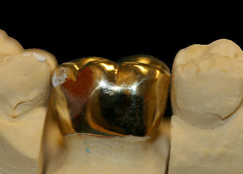 Laboratorio dental de la protección FMC del puente fino de alta densidad de la corona
