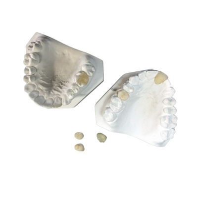 Fácil mantenga el sobrepuesto dental de cerámica blanco del embutido de la chapa de la corona del OEM