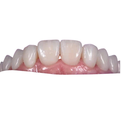 Corona dental de cerámica que blanquea de 0.3M M para substituir los dientes malsanos