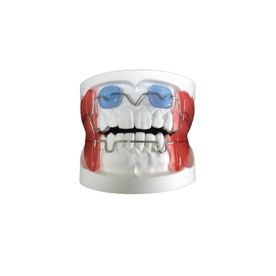 Buena fijación Anchorage adecuada del dispositivo funcional dental fijo del dispositivo