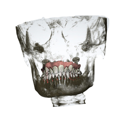 Ampliador palatal rápido del OEM del dispositivo ortodóntico desprendible exacto