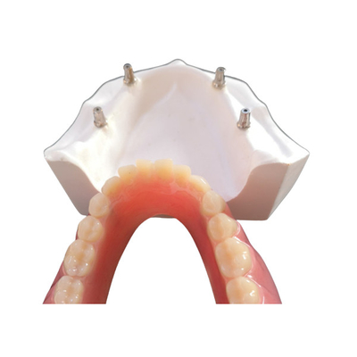 El implante dental cómodo Overdenture de la leva del cad fácil mantiene