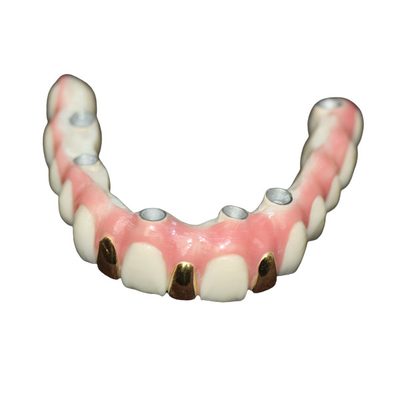 Precisión Digital 3D que imprime el metal de la barra del implante dental basado