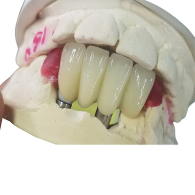 Base fuerte del Ti que muele el puente apoyado diente de las coronas del implante dental