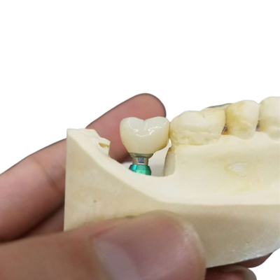 Color ultra difícilmente al OEM de la estabilidad que la corona del implante dental fácil mantiene