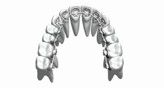 Los apoyos ortodónticos fijos de los dispositivos de la aduana enderezan los dientes Bioceramic de acero inoxidable