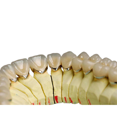 Diente natural de la porcelana del metal del laboratorio del titanio de la aleación de la corona dental dental de la porcelana