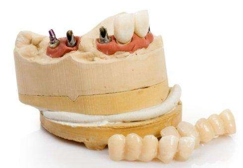 Implante dental modificado para requisitos particulares del titanio durable del reemplazo del implante dental