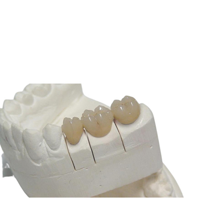 Corona dental temporal 3D del cad/de la leva PFM que imprime el arreglo para requisitos particulares de la dentadura del diseño