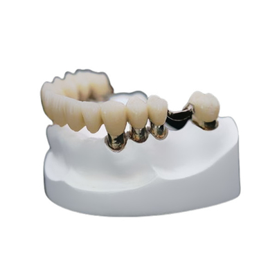 Estabilidad fuerte de la corona de la resistencia a la corrosión de la precisión de la dentadura telescópica dental del accesorio
