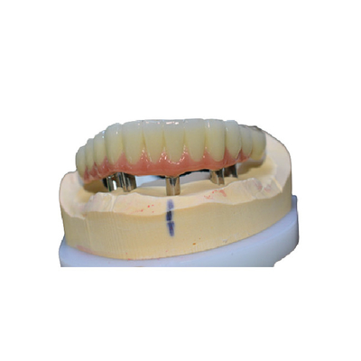 Corona de limpieza fácil del implante dental cómoda ninguna sensación del cuerpo extraño