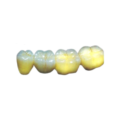 Lleve - la alergia estética de alta resistencia de la corona dental resistente de PFM amistosa