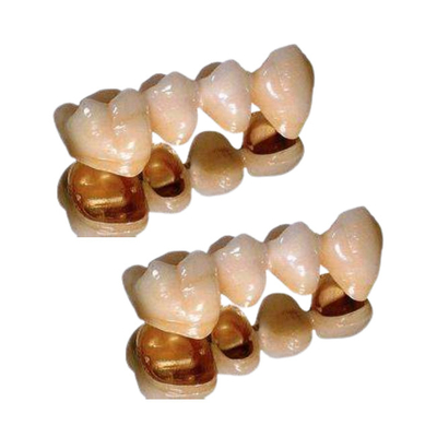 Ductilidad excelente de la corona dental de la porcelana de Palladium resistente a la corrosión