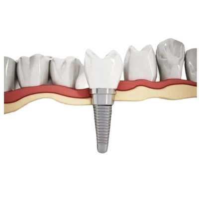 Implante dental alto Biocompatibility del titanio durable resistente a la corrosión