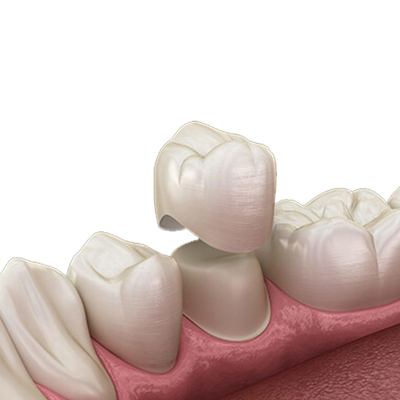 Curado duro resistente de la circona del OEM de la grieta única dental natural de la corona