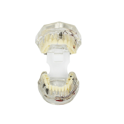 Modelo dental patológico transparente del diente con la personalización del nervio del diente