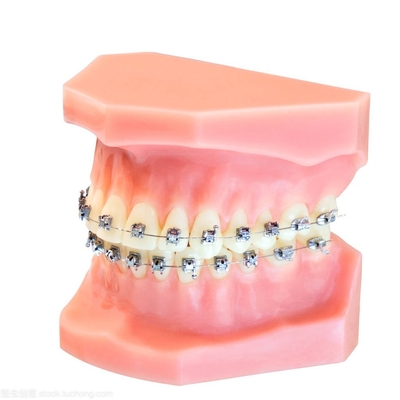 Aparatos dentales Aparatos de ortodoncia fijos Actualización de soportes de alambre blando