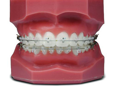 Cómodos Aparatos de Ortodoncia Fija Hermosos Brackets de Cerámica Natural