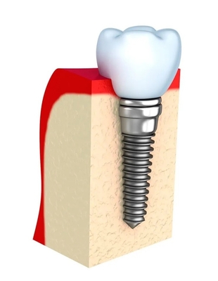Dentaduras temporales para implantes dentales, barra única, todos los dientes de cerámica