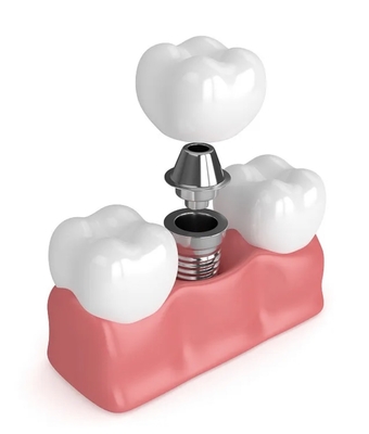 True Dentures Implants Single All Ceramic Dentaduras Dientes faltantes Empastes