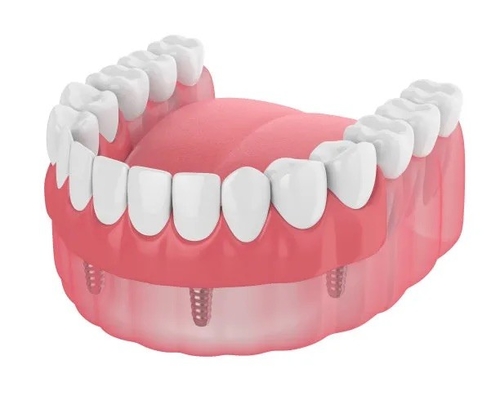 Dentaduras Dientes perdidos Barra de implantes dentales Rellenos Dentaduras postizas removibles temporales