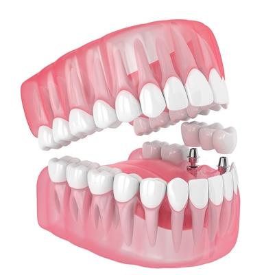 Solo todos los implantes dentales de dientes de cerámica que faltan dentaduras de relleno muelas del juicio