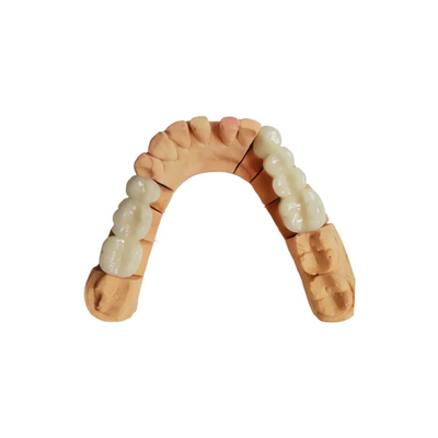 Coloree la resistencia dental estable del ácido y del álcali de la corona de PFM no fácil de llevar