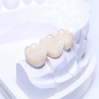 Garantía de alta calidad del puente dental parcial desprendible superficial liso de las dentaduras PFM