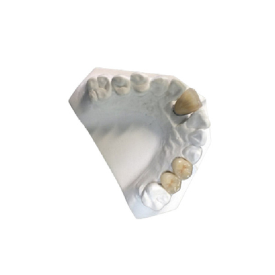 Corona de cerámica de alta resistencia del laboratorio dental PFM de la corona de la porcelana del oro amarillo