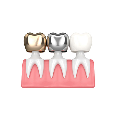 Buenas coronas y puentes dentales de Biocompatibility no fáciles llevar el establo del color