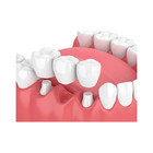 La resistencia de desgaste fuerte dental cómoda de las coronas y de los puentes hace sonrisa más dulce