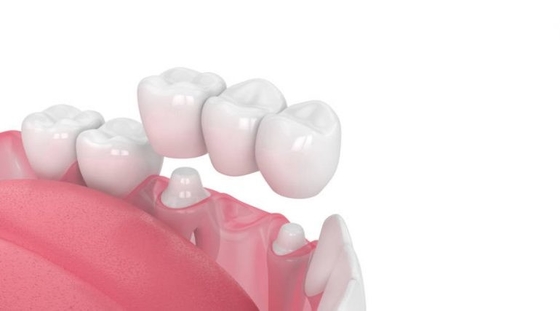 Buena fuerza de la mordedura de la estabilidad de la corona del aspecto realista dental de alta resistencia del puente