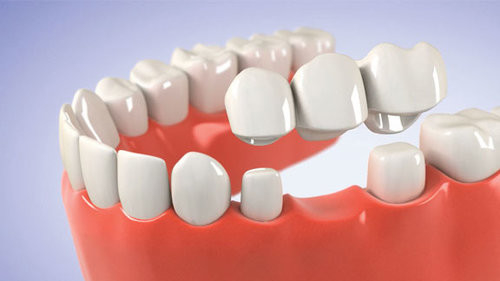 Buena fuerza de la mordedura de la estabilidad de la corona del aspecto realista dental de alta resistencia del puente