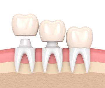 Buenas coronas y puentes dentales de Biocompatibility no fáciles llevar el establo del color