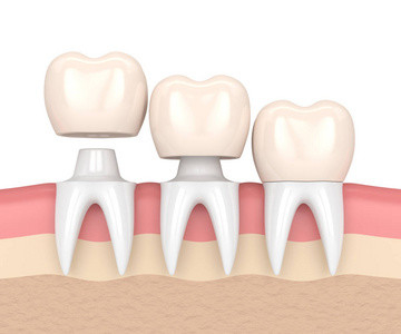 Las coronas y los puentes dentales hermosos alisan la superficie para la seguridad de la higiene oral