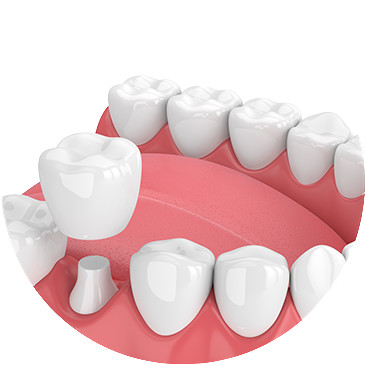 Las coronas y los puentes dentales hermosos alisan la superficie para la seguridad de la higiene oral