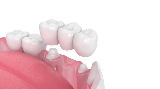 Resistencia dental buen Biocompatibility del ácido y del álcali de la corona de la porcelana