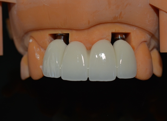 Diseño CAD/CAM preciso de corona dental de zirconia para el ajuste