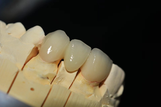 Laboratorio dental de dentadura de zirconia personalizado - Entrega y reparación rápida