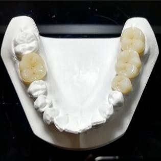 Calidad constante las coronas de Mark Of Our Ceramic Dental