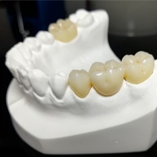 Calidad constante las coronas de Mark Of Our Ceramic Dental