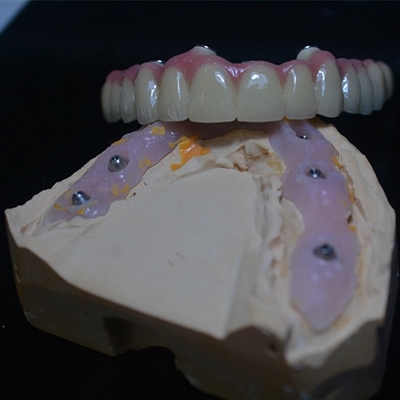 El arreglo para requisitos particulares apto perfecto en nuestras coronas del implante dental